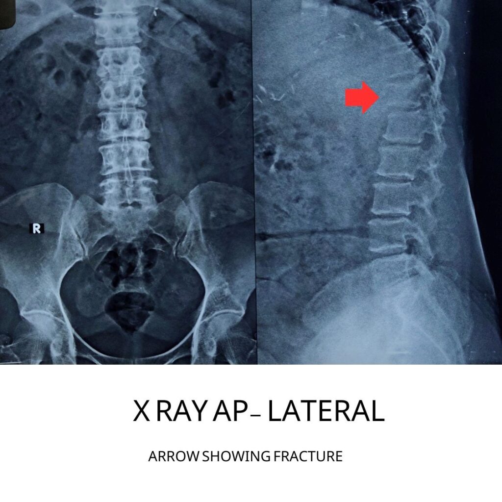 kyphoplasty in indore