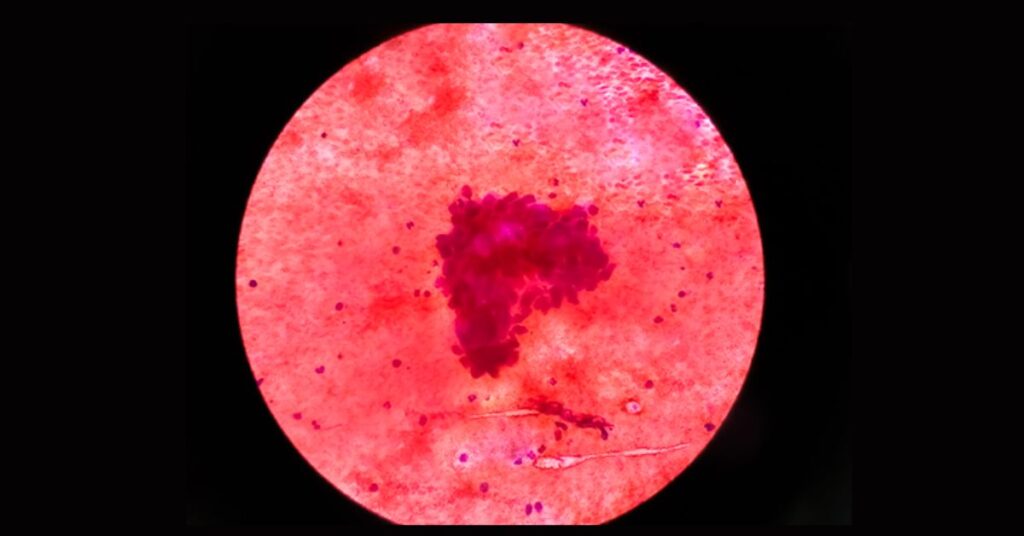 Superior hypogastric plexus neurolysis performed for refractory pelvic pain in a post-prostatectomy patient by Dr. Anshul Agrawal