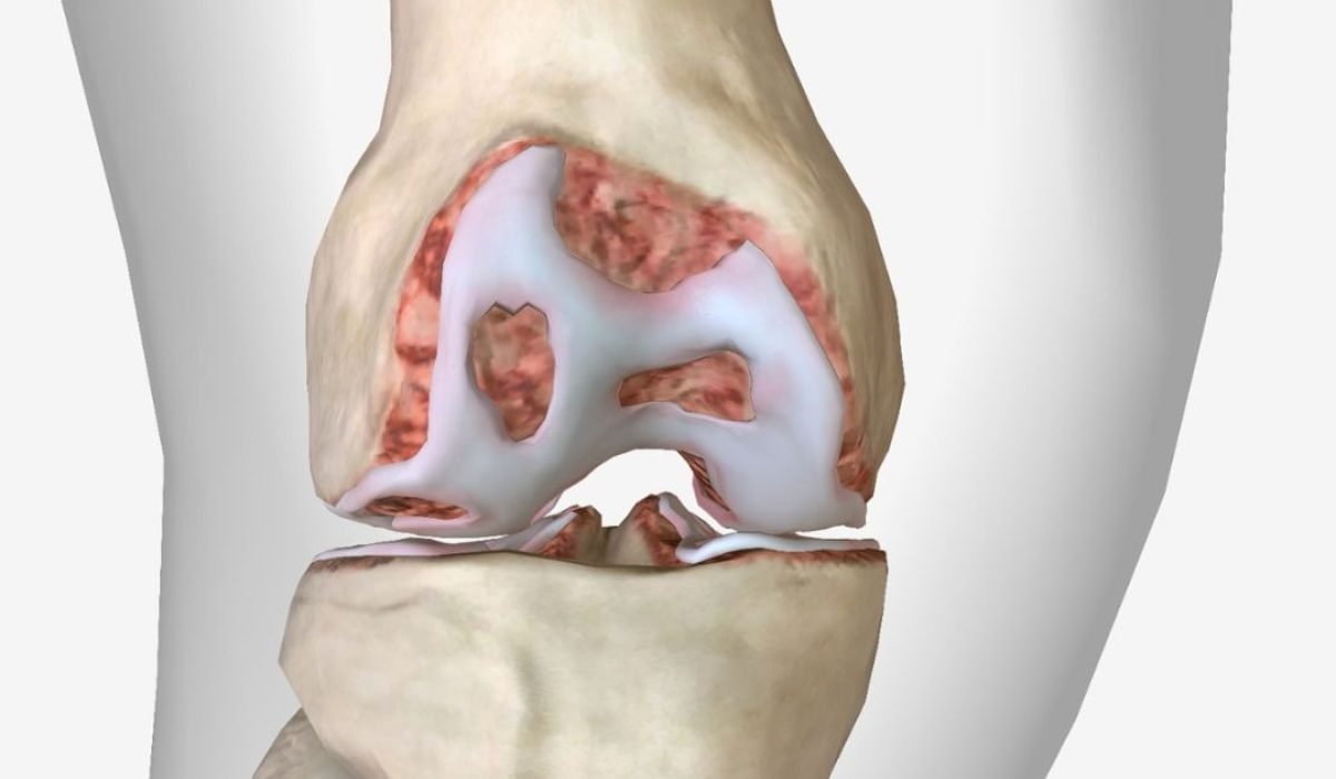 ligament tear
